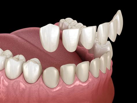 veneers elk point sd|Elk Point Dental Care, Elk Point, SD .